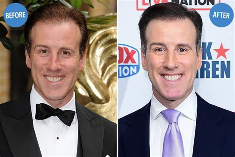 anton du beke teeth